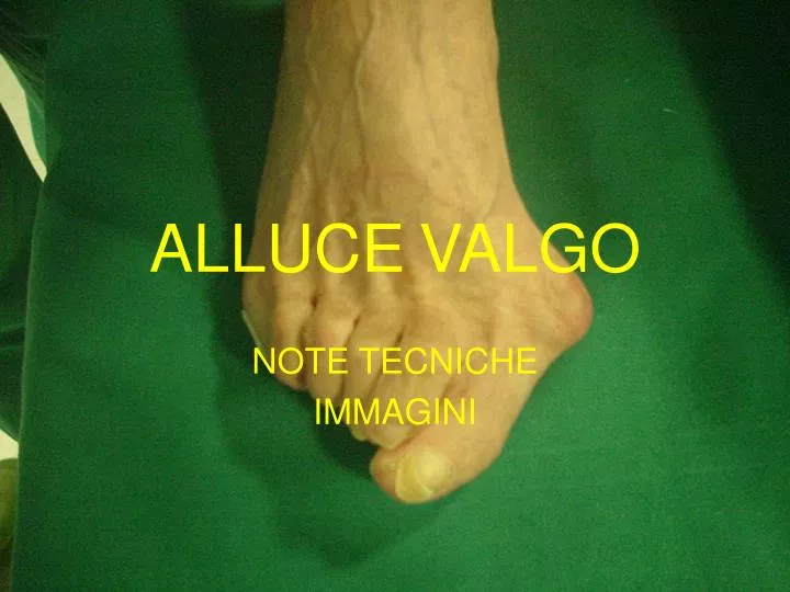 alluce valgo