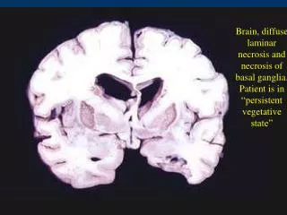 Brain, diffuse laminar necrosis and necrosis of basal ganglia.