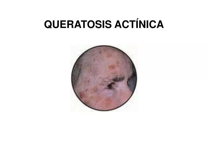 queratosis act nica