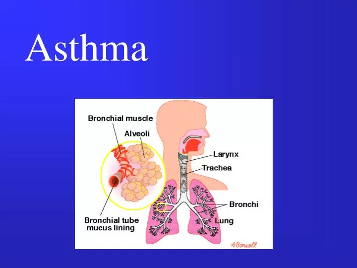 Ppt Asthma Powerpoint Presentation Free Download Id 2991929