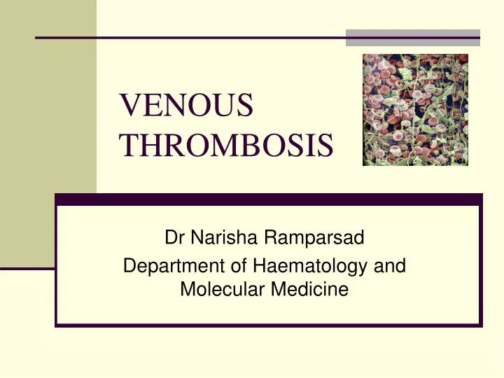 venous thrombosis
