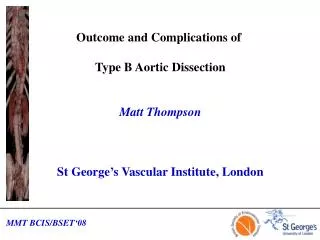 Outcome and Complications of Type B Aortic Dissection Matt Thompson