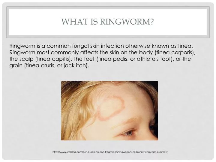 what is ringworm