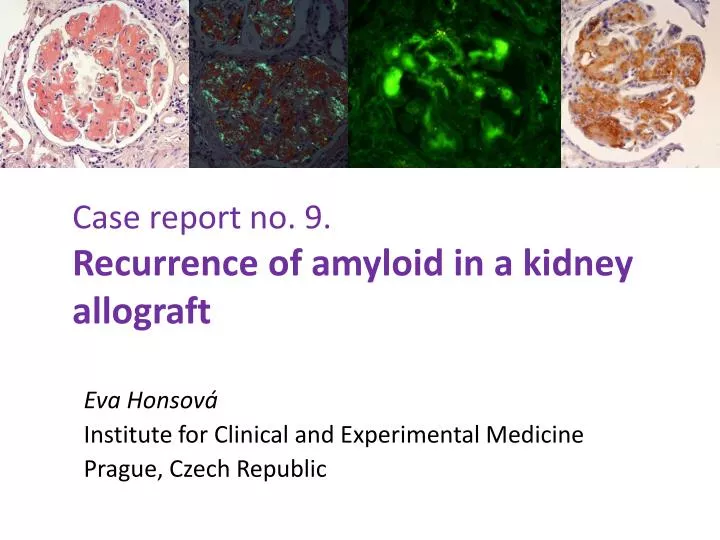 case report no 9 recurrence of amyloid in a kidney allograft