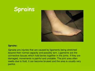 sprains