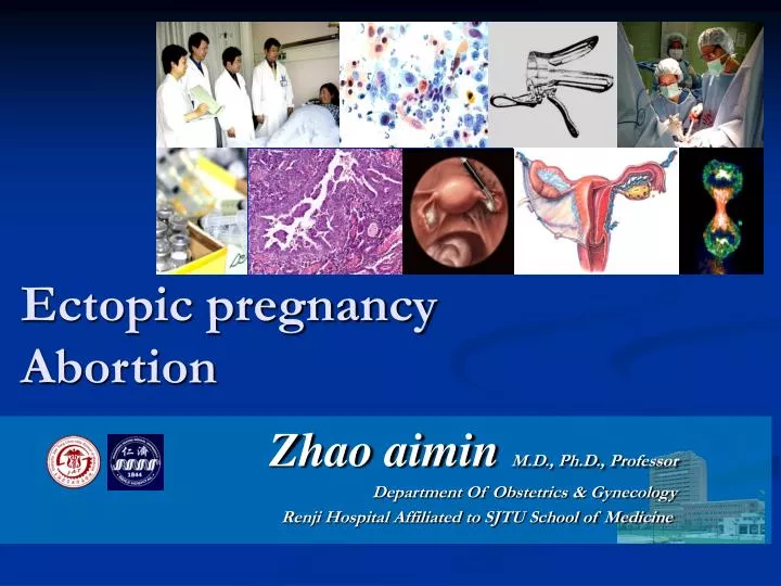 ectopic pregnancy abortion