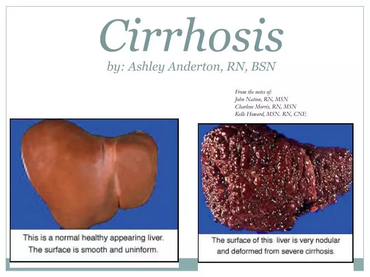 cirrhosis by ashley anderton rn bsn