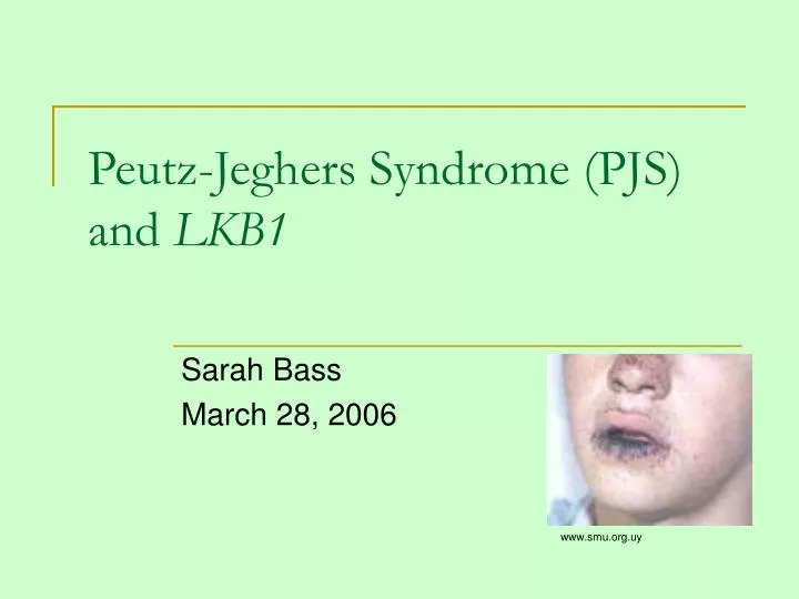 peutz jeghers syndrome pjs and lkb1