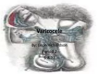 Varicocele