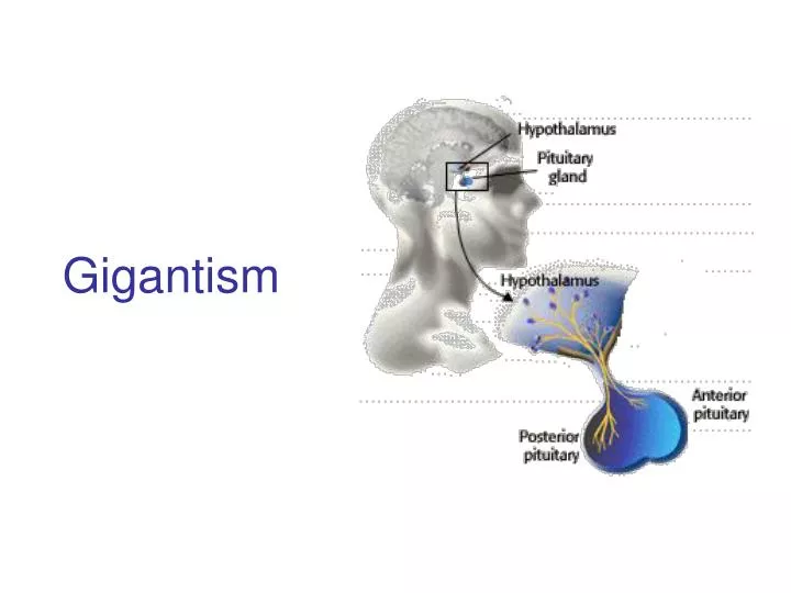 gigantism