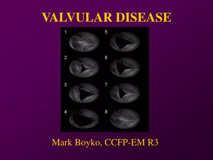 valvular disease