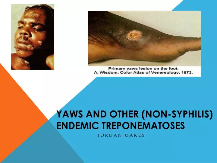 yaws and other non syphilis endemic t reponematoses