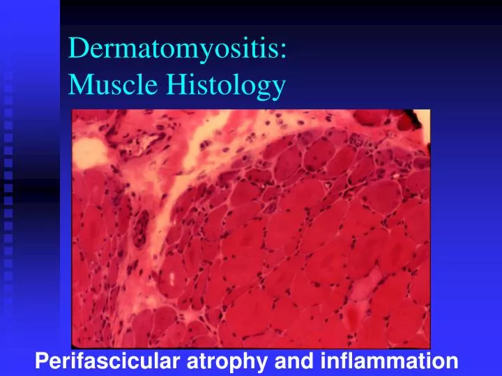 dermatomyositis muscle histology