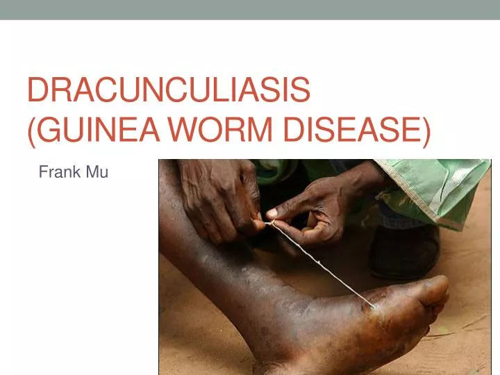 dracunculiasis guinea worm disease