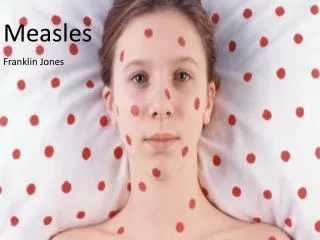 Measles