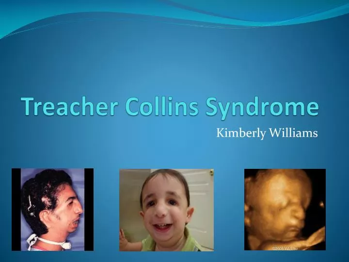 treacher collins syndrome