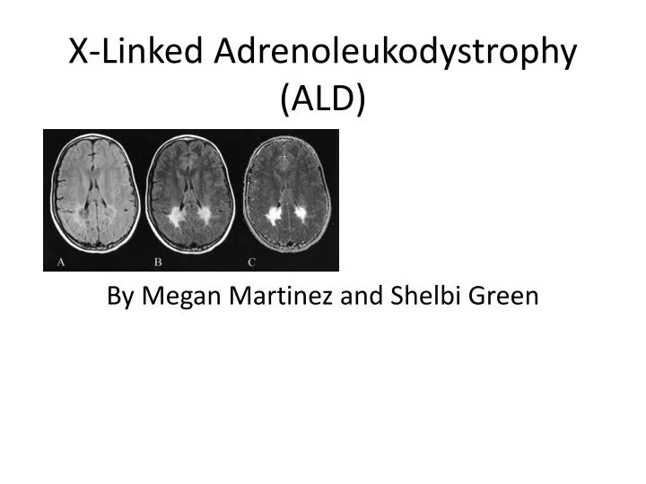 x linked adrenoleukodystrophy ald