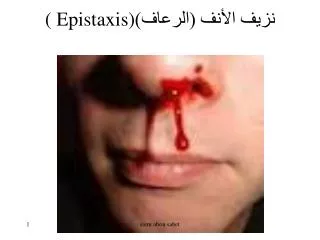 epistaxis