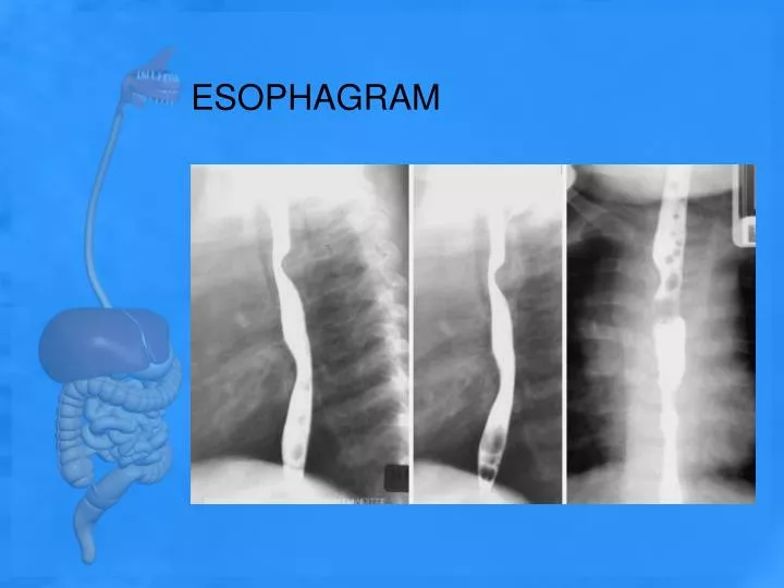 esophagram