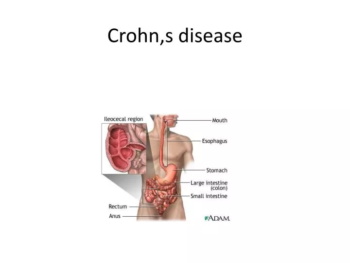 crohn s disease