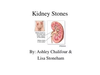 Kidney Stones