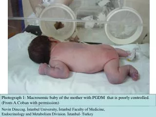 Photograph 1: Macrosomic baby of the mother with PGDM that is poorly controlled.