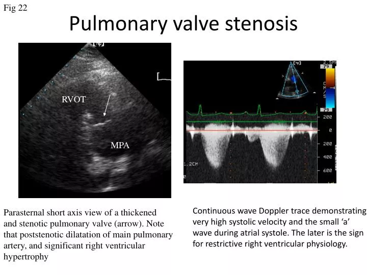 pulmonary valve stenosis