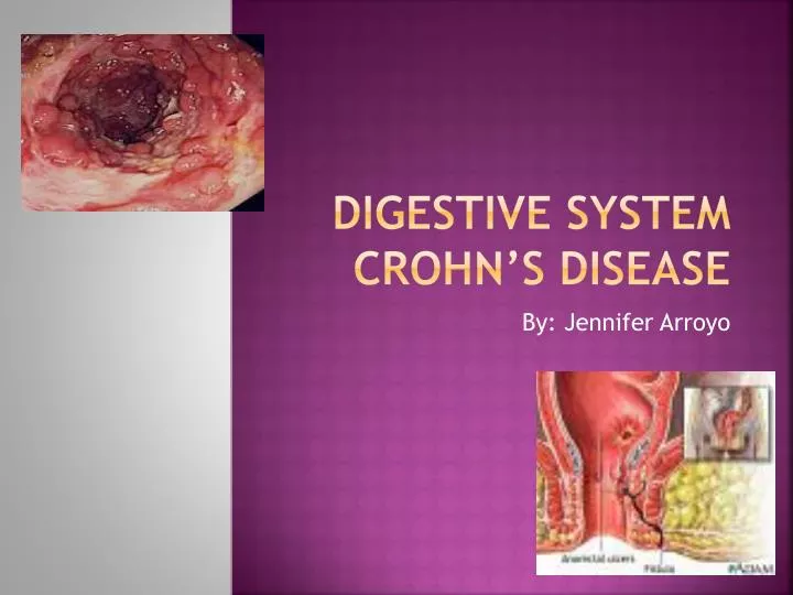 digestive system crohn s disease