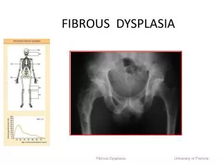 FIBROUS DYSPLASIA