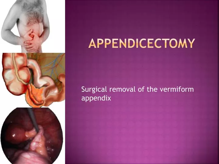 appendicectomy