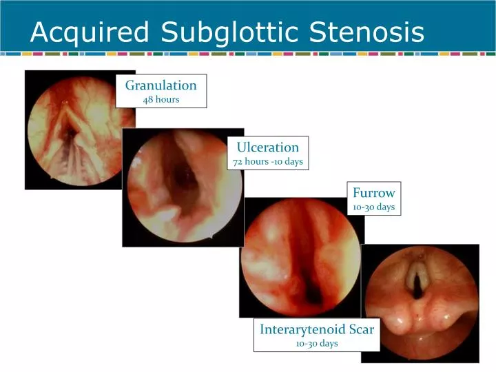 acquired subglottic stenosis