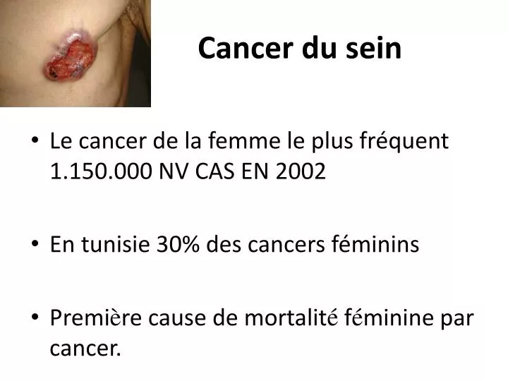 cancer du sein