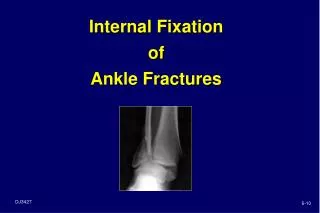Internal Fixation of Ankle Fractures