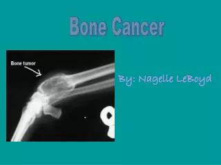 Bone Cancer