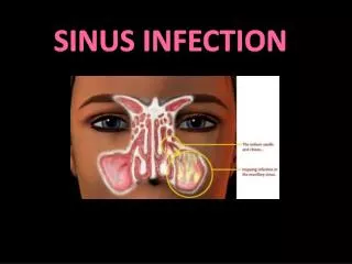 Sinus infection