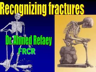 Recognizing fractures
