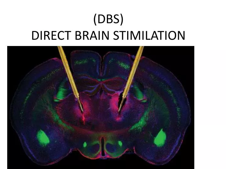 dbs direct brain stimilation