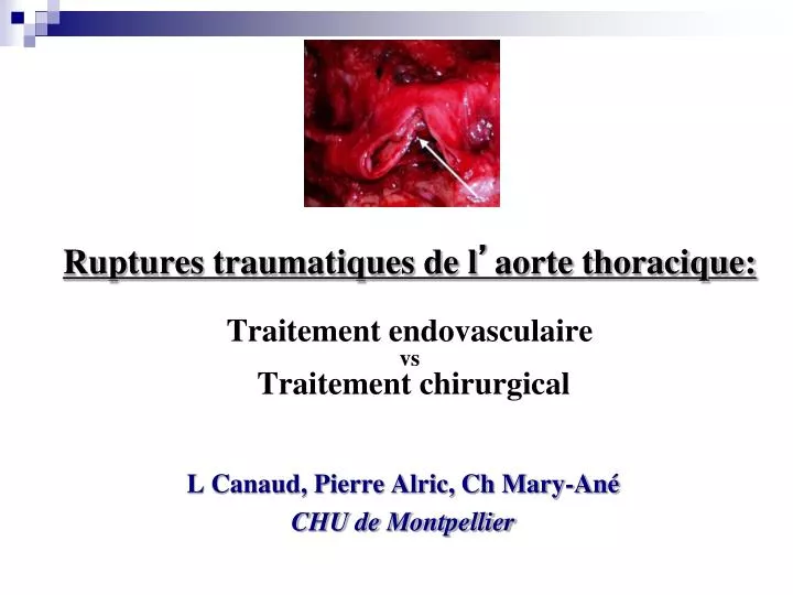 ruptures traumatiques de l aorte thoracique traitement endovasculaire vs traitement chirurgical