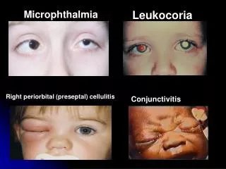 Microphthalmia