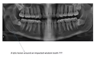 A lytic lesion around an impacted wisdom tooth ???