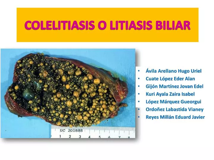colelitiasis o litiasis biliar