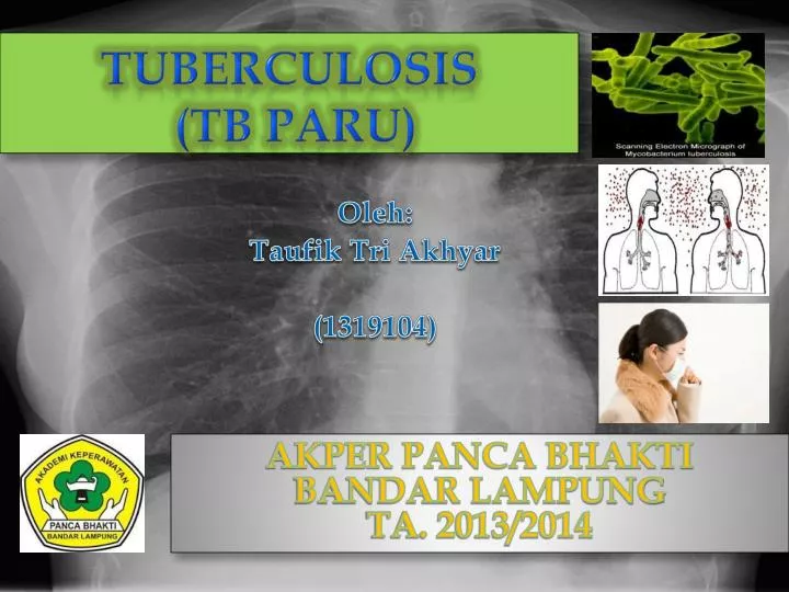tuberculosis tb paru