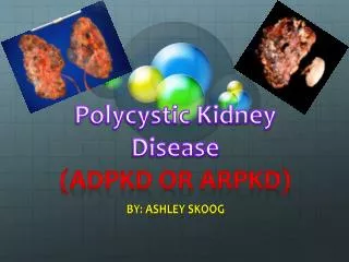 Polycystic Kidney Disease (ADPKD OR ARPKD)