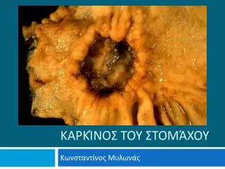 Καρκίνος του Στομάχου