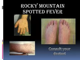 Rocky Mountain Spotted Fever