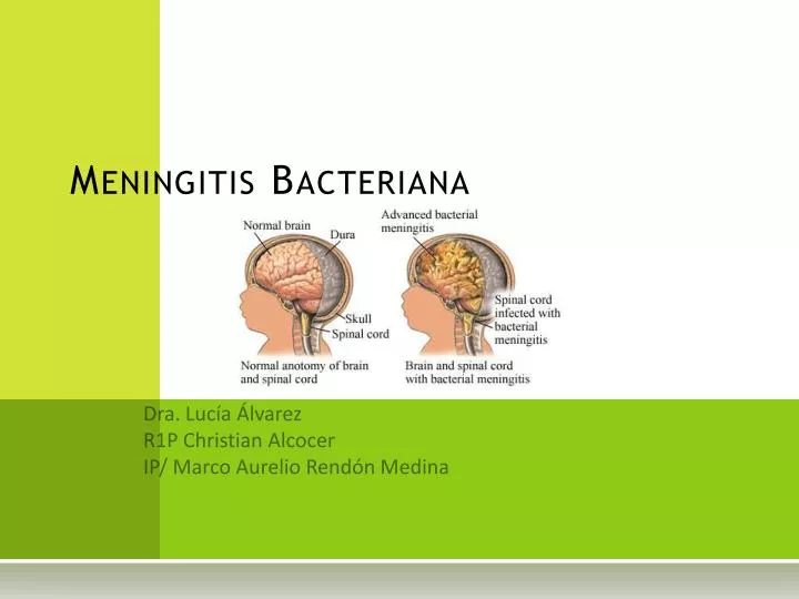 meningitis bacteriana