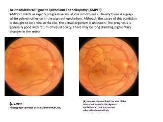 Acute Multifocal Pigment Epithelium Epitheliopathy (AMPEE)