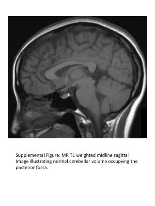Supplemental Figure: MR T1 weighted midline sagittal