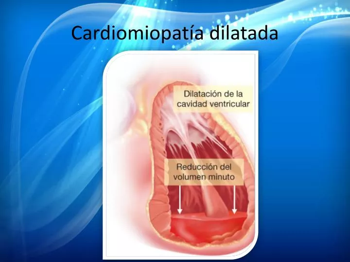 cardiomiopat a dilatada