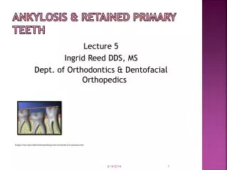 Ankylosis &amp; Retained Primary Teeth
